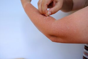sun-poison-symptoms-and-treatment