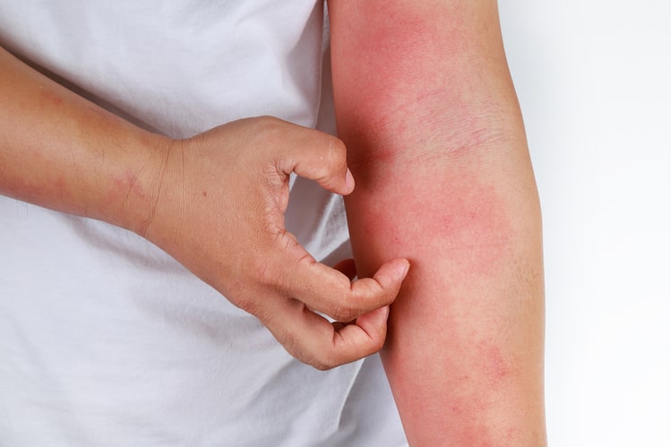 rashes-treatment-at-urgent-care