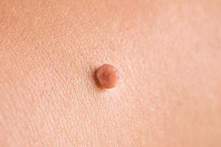 skin-tags-removal-at-urgent-care