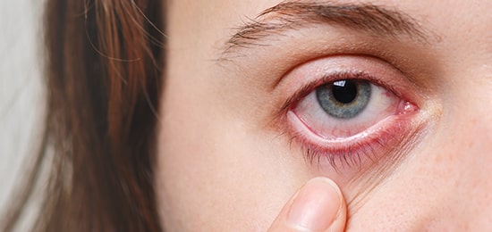 pink eye illness treatment