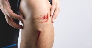 Cuts Or Scrapes