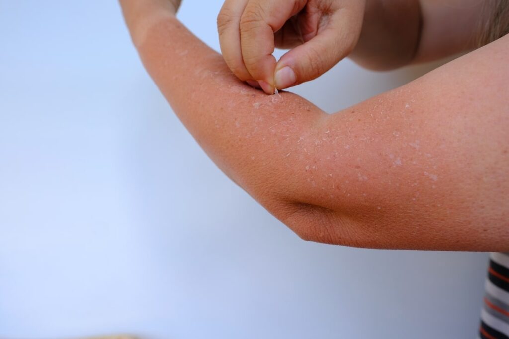 Sun Poisoning Symptoms, Treatment and Care with Prevention!