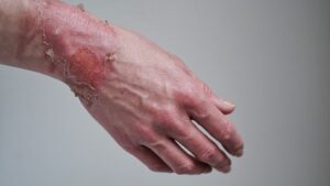 burn treatment at family urgent care