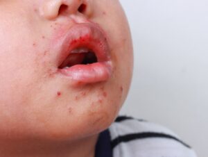 hand-foot-and-mouth-treatment-at-urgent-care-indiana-and-chicago