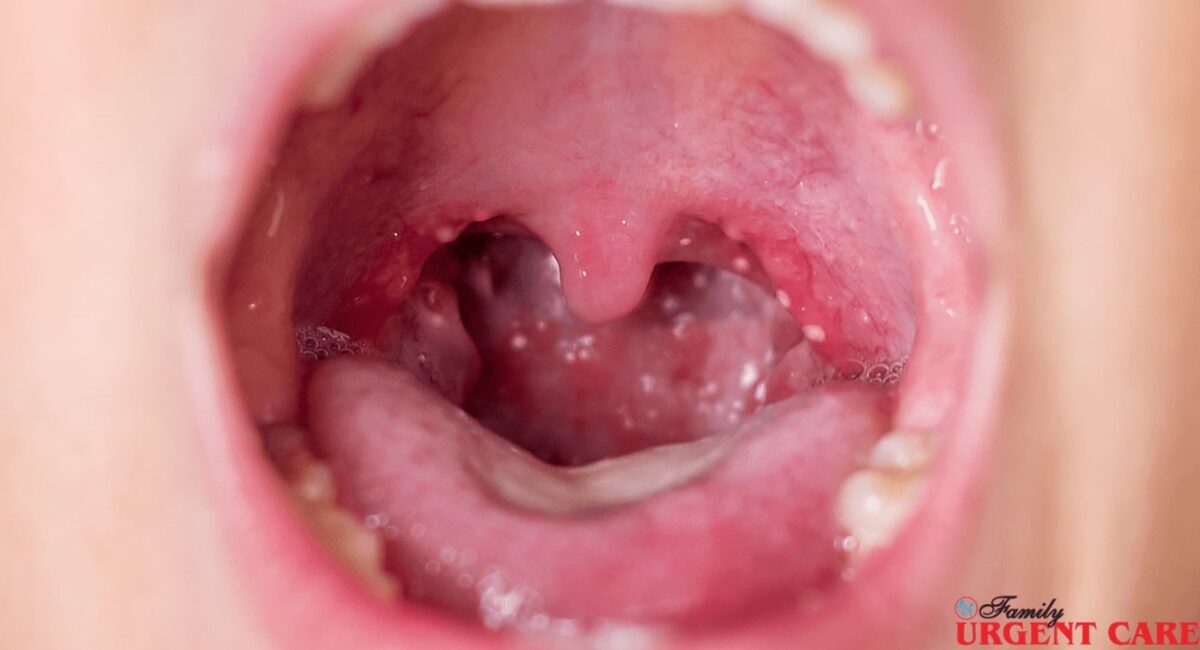 why-are-my-tonsils-swollen
