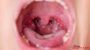 why-are-my-tonsils-swollen