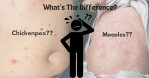 difference between measles and chickenpox