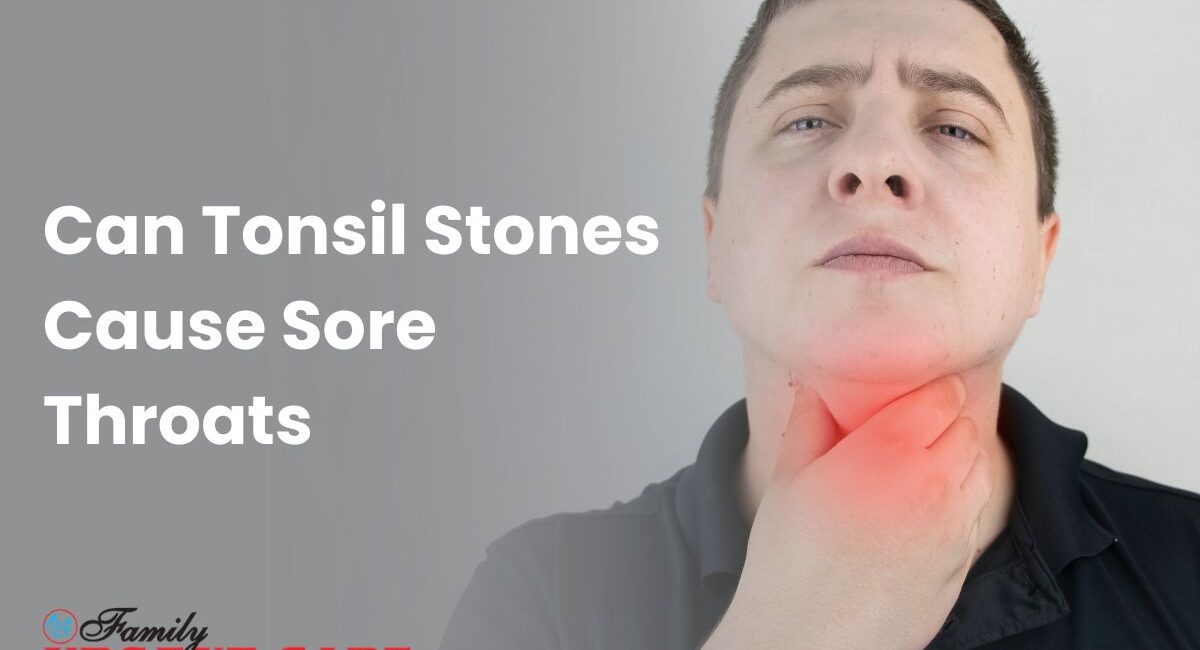 Can Tonsil Stones Cause Sore Throats