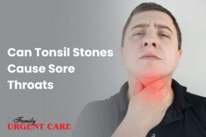 Can Tonsil Stones Cause Sore Throats