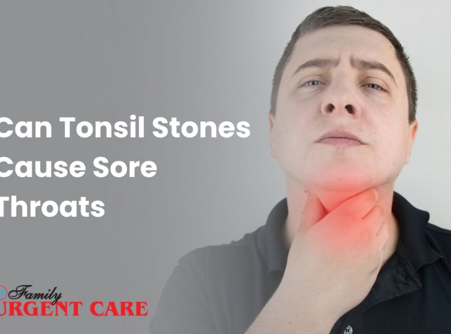 Can Tonsil Stones Cause Sore Throats
