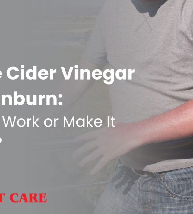 Apple cider vinegar for sunburn
