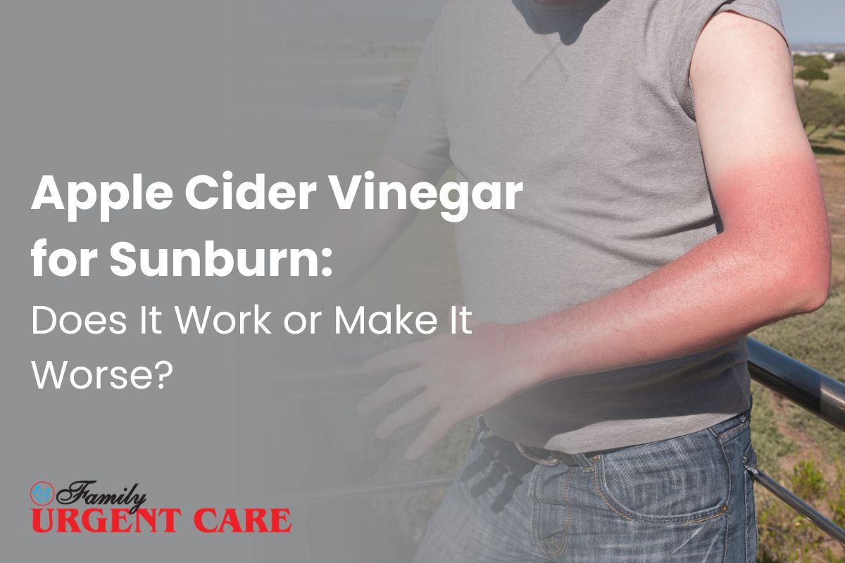 Apple cider vinegar for sunburn