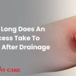 How Long Does An Abscess Take To Heal After Drainage