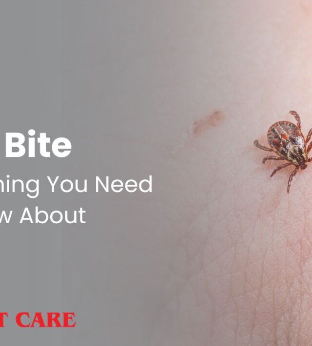 Tick bite every you need to know about